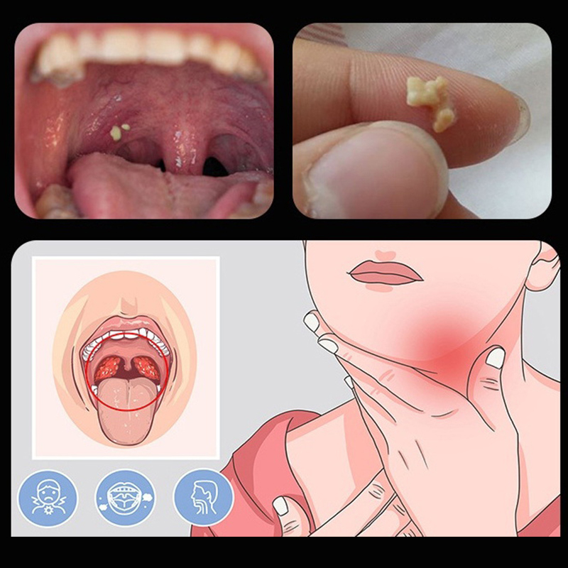 ~Oorsmeer- en tonsilstenenverw - Ear Wax Remover recensie en prijs